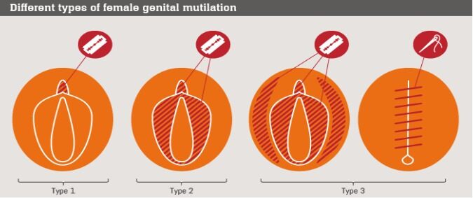 Female genital mutilation